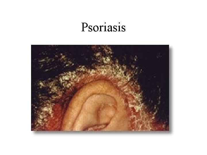 Psoriasis 