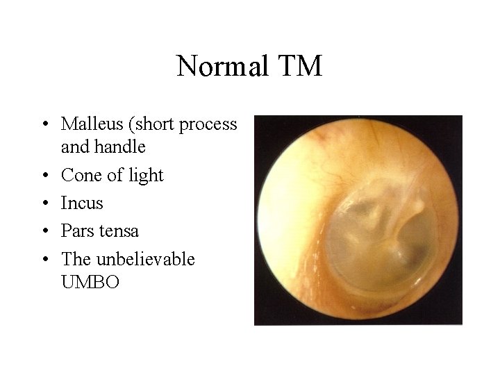 Normal TM • Malleus (short process and handle • Cone of light • Incus