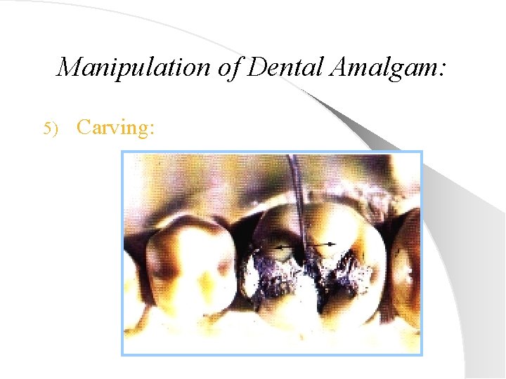 Manipulation of Dental Amalgam: 5) Carving: 