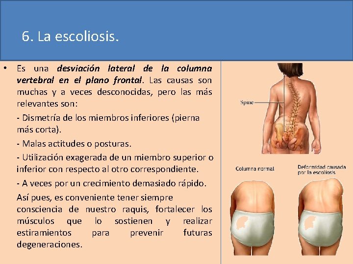 6. La escoliosis. • Es una desviación lateral de la columna vertebral en el