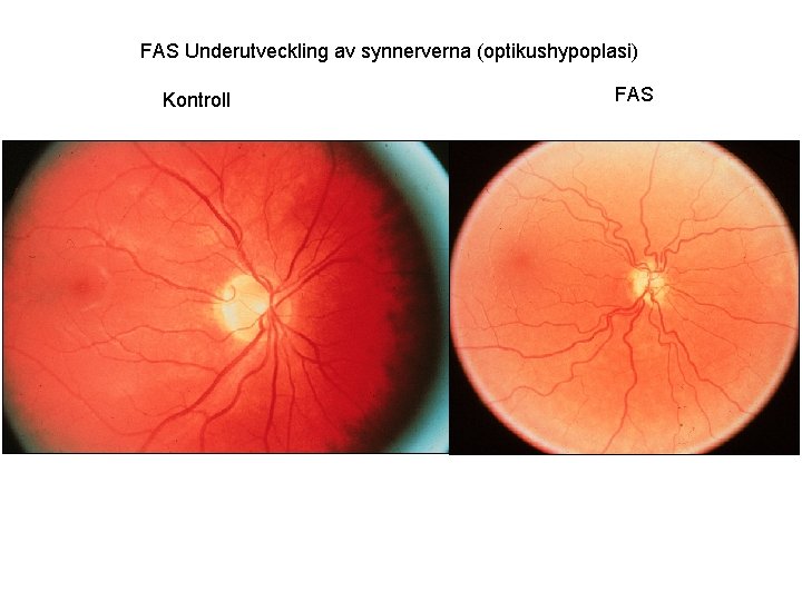 FAS Underutveckling av synnerverna (optikushypoplasi) Kontroll FAS 