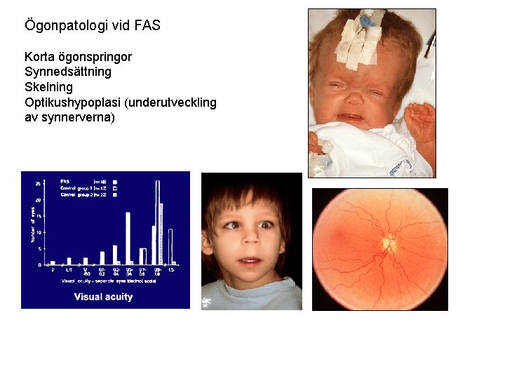 Ögonpatologi vid FAS Korta ögonspringor Synnedsättning Skelning Optikushypoplasi (underutveckling av synnerverna) 