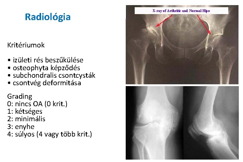 Radiológia Kritériumok • izületi rés beszűkülése • osteophyta képződés • subchondralis csontcysták • csontvég