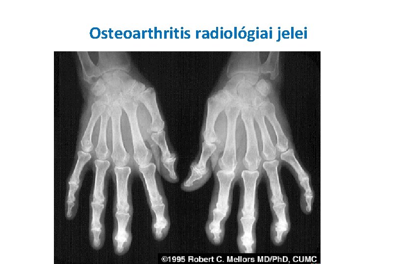 Osteoarthritis radiológiai jelei 