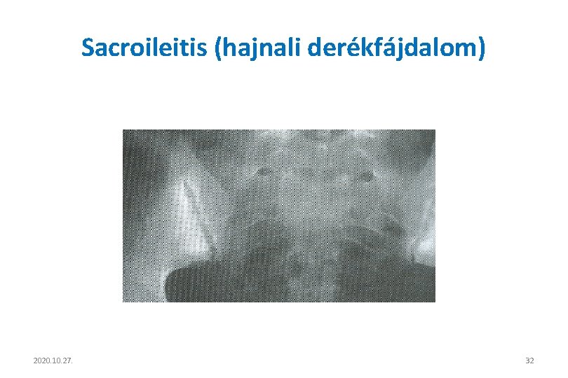 Sacroileitis (hajnali derékfájdalom) 2020. 10. 27. 32 