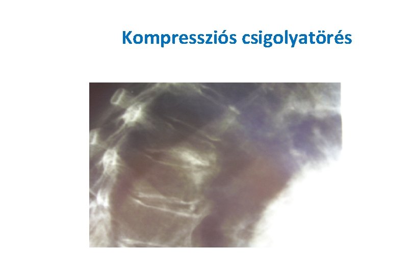 Kompressziós csigolyatörés 