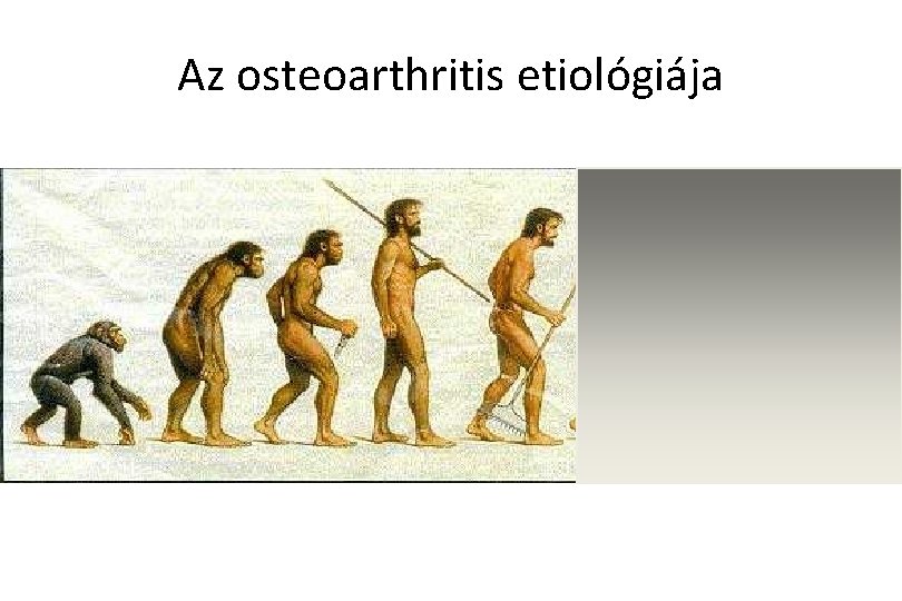 Az osteoarthritis etiológiája 