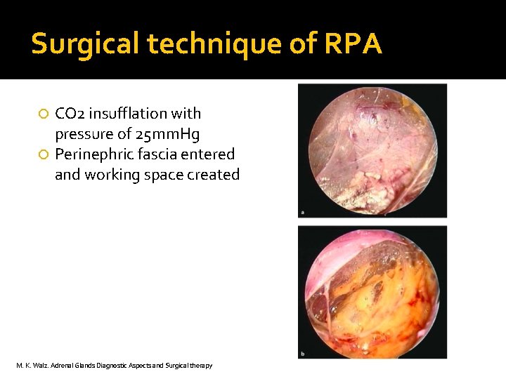 Surgical technique of RPA CO 2 insufflation with pressure of 25 mm. Hg Perinephric