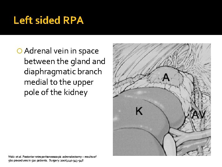 Left sided RPA Adrenal vein in space between the gland diaphragmatic branch medial to