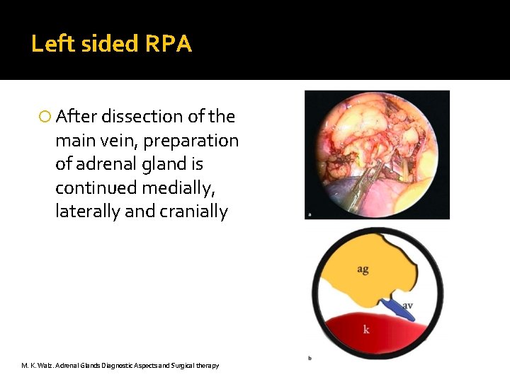 Left sided RPA After dissection of the main vein, preparation of adrenal gland is