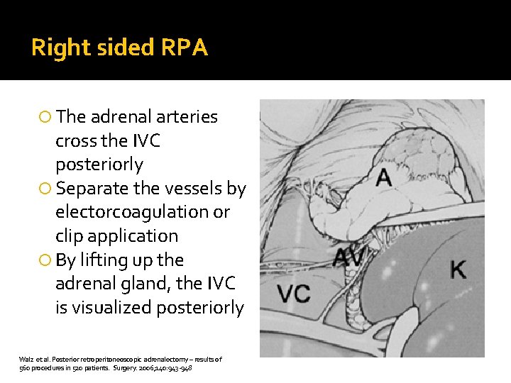 Right sided RPA The adrenal arteries cross the IVC posteriorly Separate the vessels by