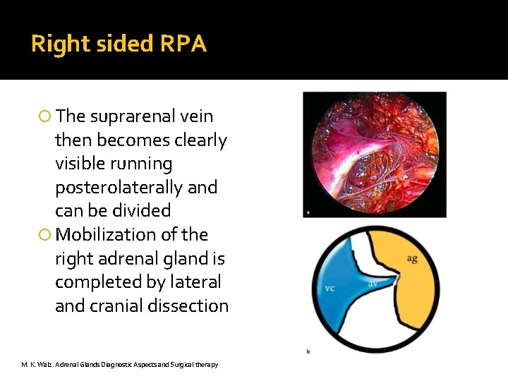 Right sided RPA The suprarenal vein then becomes clearly visible running posterolaterally and can