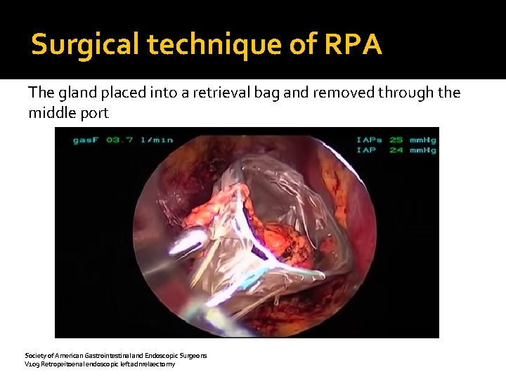 Surgical technique of RPA The gland placed into a retrieval bag and removed through