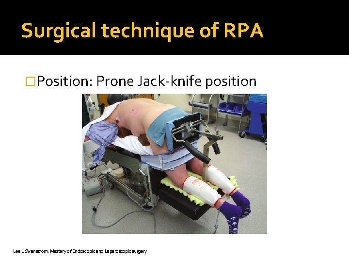 Surgical technique of RPA �Position: Prone Jack-knife position Lee L Swanstrom. Mastery of Endoscopic