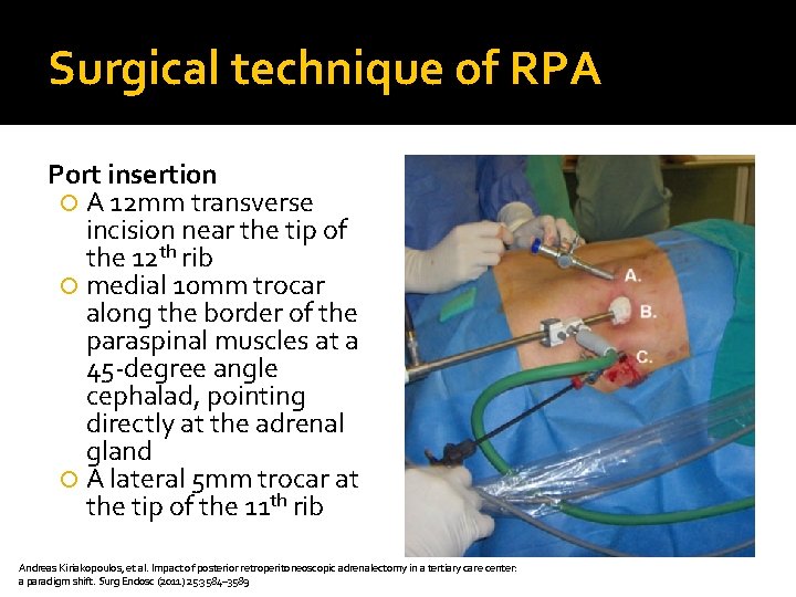 Surgical technique of RPA Port insertion A 12 mm transverse incision near the tip