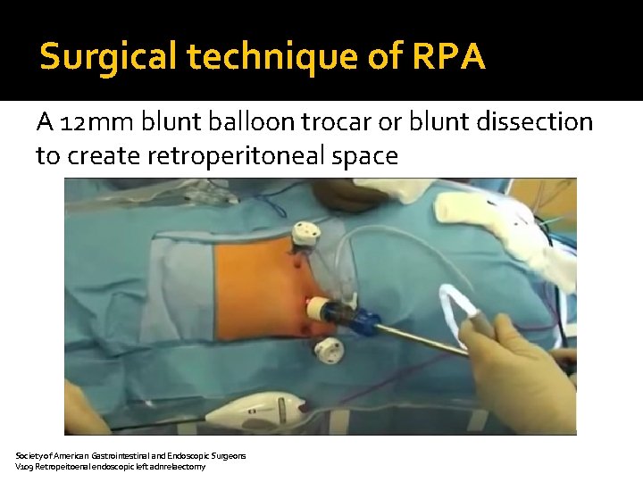 Surgical technique of RPA A 12 mm blunt balloon trocar or blunt dissection to