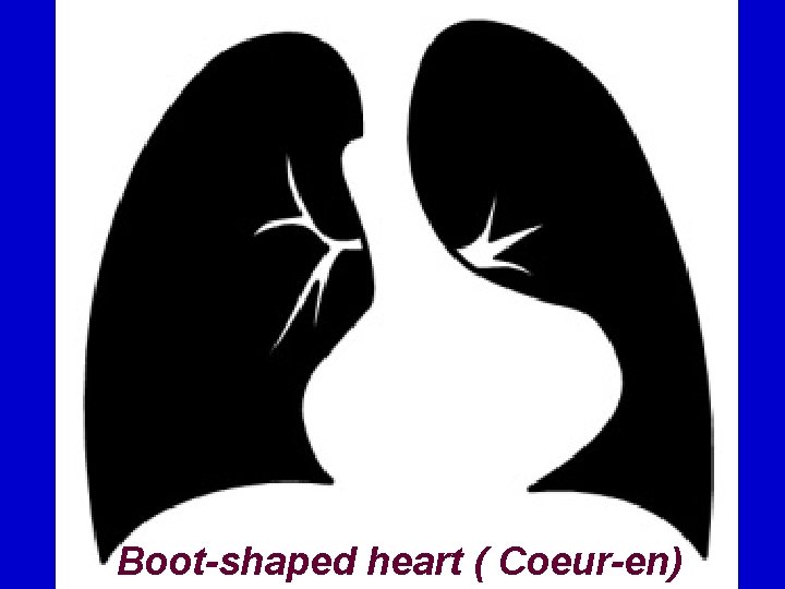 Boot-shaped heart ( Coeur-en) 