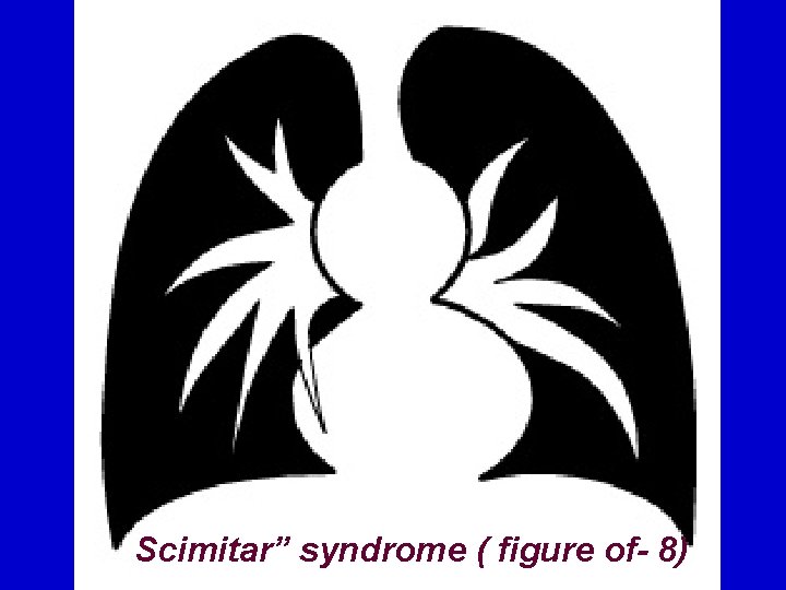 Scimitar” syndrome ( figure of- 8) 
