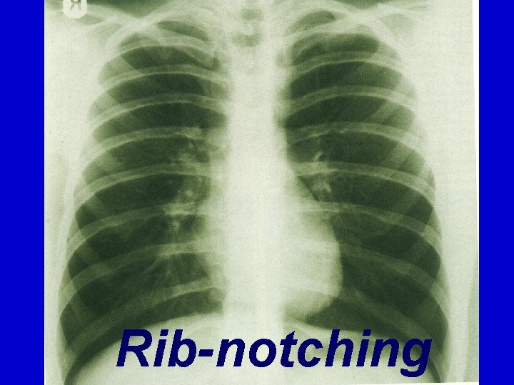 Rib-notching 