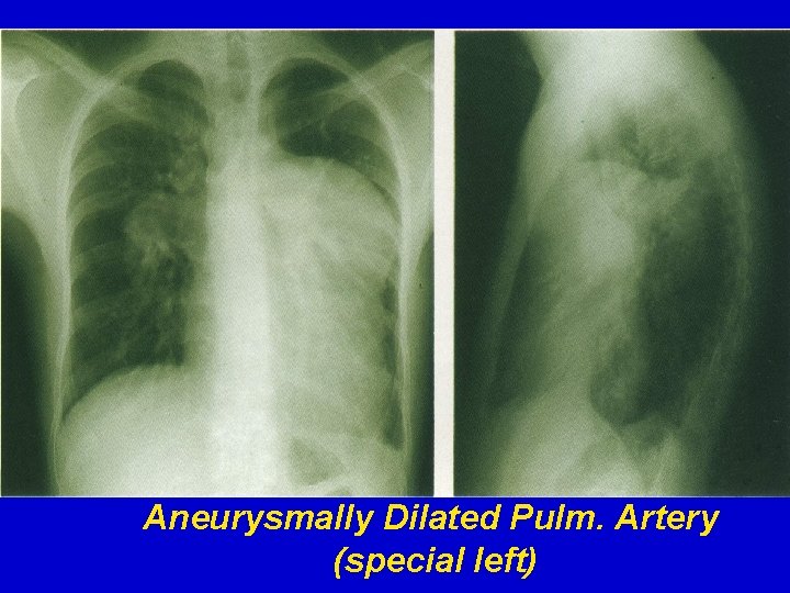 Aneurysmally Dilated Pulm. Artery (special left) 