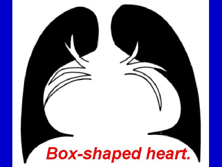 Box-shaped heart. 
