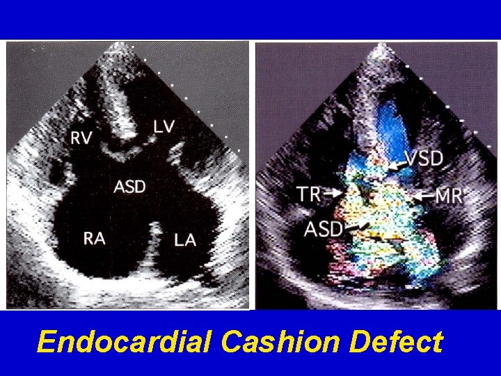 Endocardial Cashion Defect 
