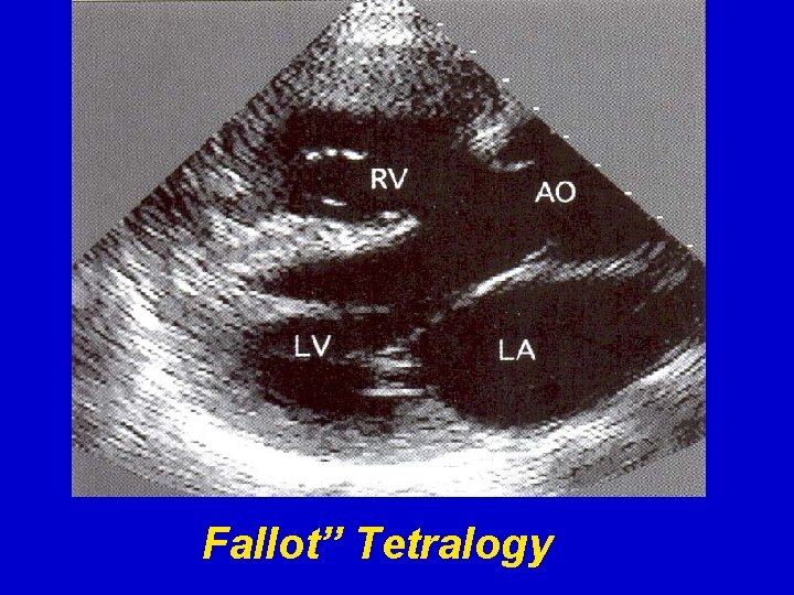 Fallot” Tetralogy 