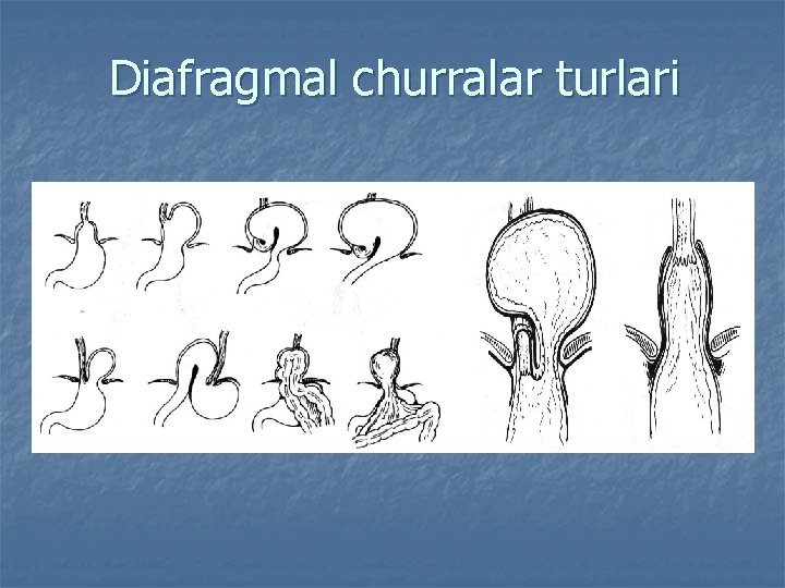 Diafragmal churralar turlari 