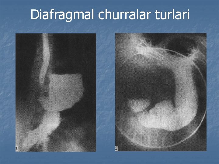 Diafragmal churralar turlari 