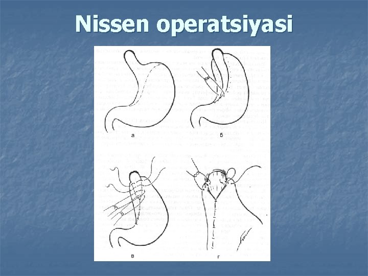 Nissen operatsiyasi 