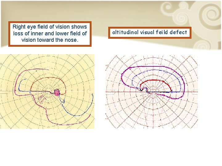 Right eye field of vision shows loss of inner and lower field of vision