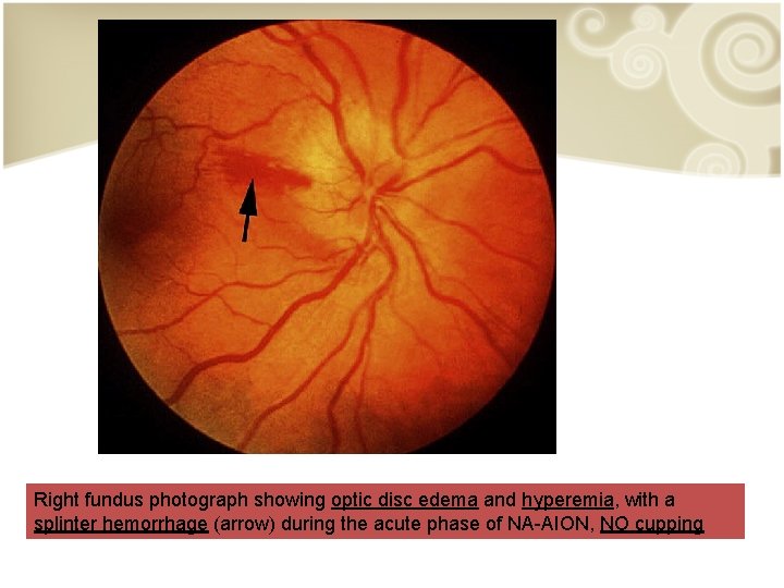 Right fundus photograph showing optic disc edema and hyperemia, with a splinter hemorrhage (arrow)