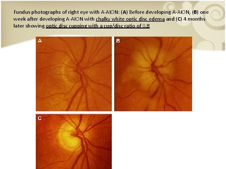 Fundus photographs of right eye with A-AION: (A) Before developing A-AION, (B) one week