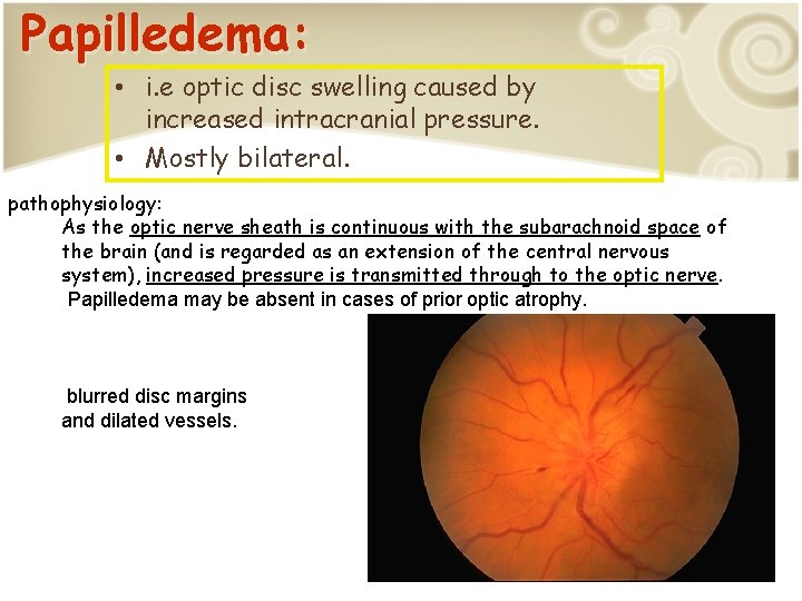 Papilledema: • i. e optic disc swelling caused by increased intracranial pressure. • Mostly