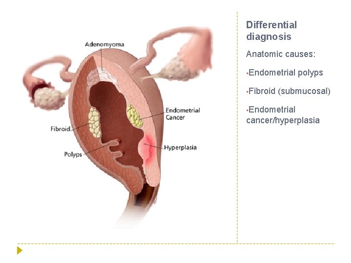 Differential diagnosis Anatomic causes: • Endometrial • Fibroid polyps (submucosal) • Endometrial cancer/hyperplasia 