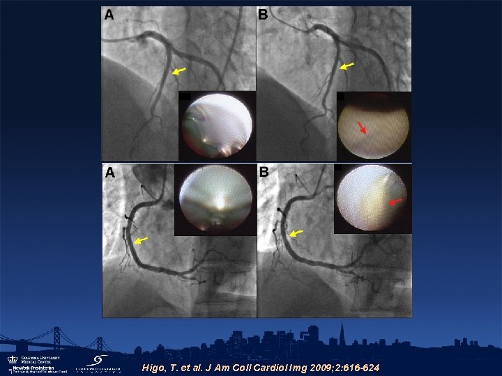 Higo, T. et al. J Am Coll Cardiol Img 2009; 2: 616 -624 