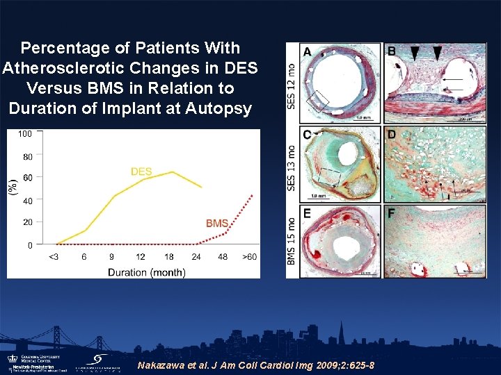 Percentage of Patients With Atherosclerotic Changes in DES Versus BMS in Relation to Duration