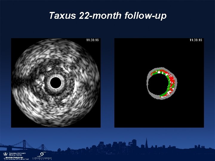 Taxus 22 -month follow-up 