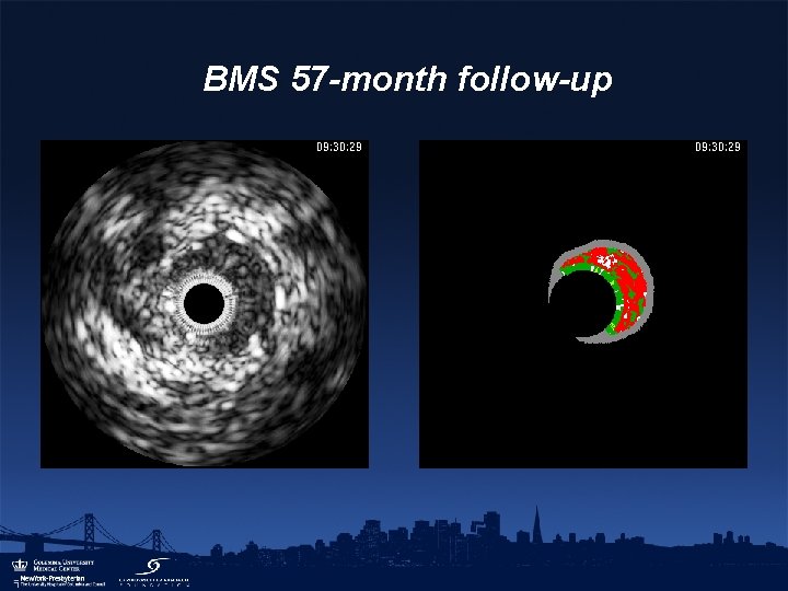 BMS 57 -month follow-up 