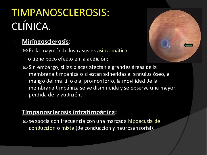 TIMPANOSCLEROSIS: CLÍNICA. Miringosclerosis: En la mayoría de los casos es asintomática o tiene poco
