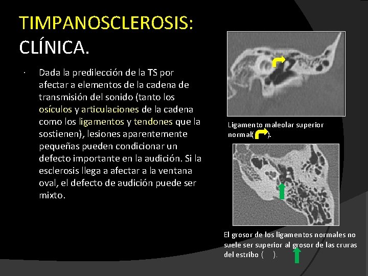 TIMPANOSCLEROSIS: CLÍNICA. Dada la predilección de la TS por afectar a elementos de la