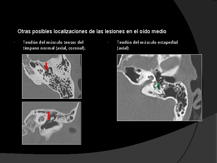 Otras posibles localizaciones de las lesiones en el oído medio Tendón del músculo tensor