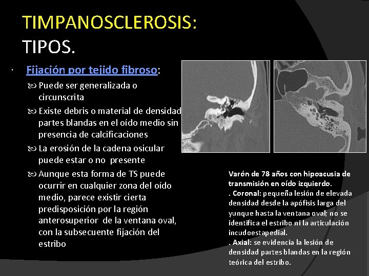 TIMPANOSCLEROSIS: TIPOS. Fijación por tejido fibroso: Puede ser generalizada o circunscrita Existe debris o
