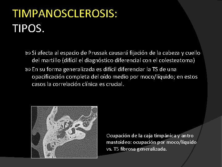 TIMPANOSCLEROSIS: TIPOS. Si afecta al espacio de Prussak causará fijación de la cabeza y