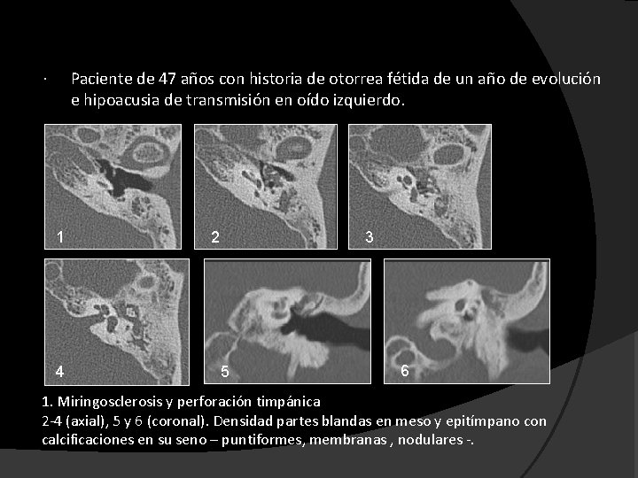 Paciente de 47 años con historia de otorrea fétida de un año de evolución