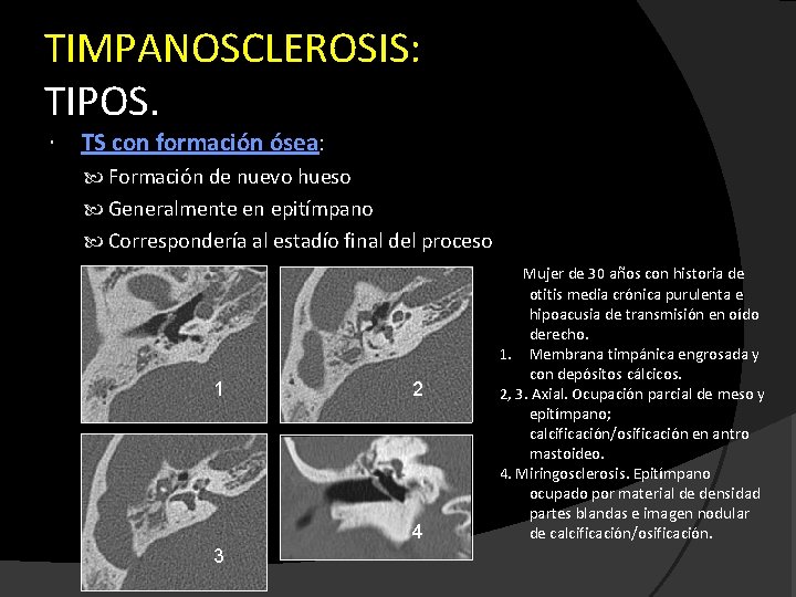 TIMPANOSCLEROSIS: TIPOS. TS con formación ósea: Formación de nuevo hueso Generalmente en epitímpano Correspondería