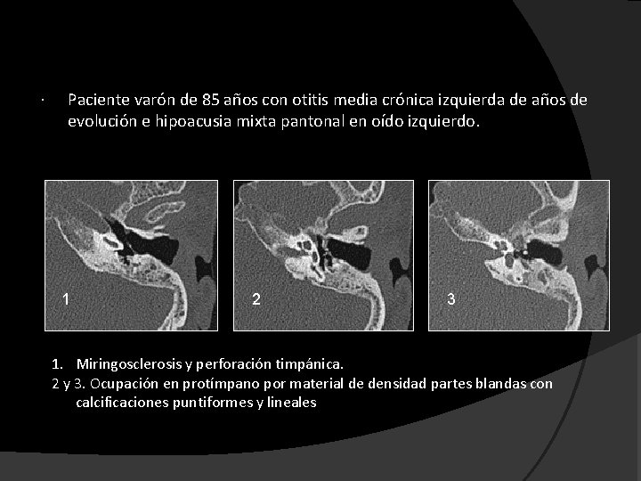  Paciente varón de 85 años con otitis media crónica izquierda de años de
