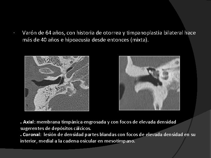  Varón de 64 años, con historia de otorrea y timpanoplastia bilateral hace más