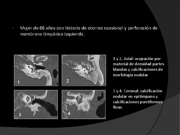 Mujer de 66 años con historia de otorrea ocasional y perforación de membrana timpánica