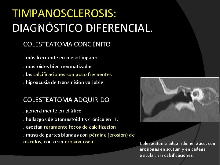 TIMPANOSCLEROSIS: DIAGNÓSTICO DIFERENCIAL. COLESTEATOMA CONGÉNITO. más frecuente en mesotímpano. mastoides bien neumatizadas. las calcificaciones